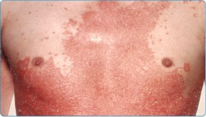 What Is Psoriasis?